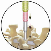 METRx MicroDiscectomy System
