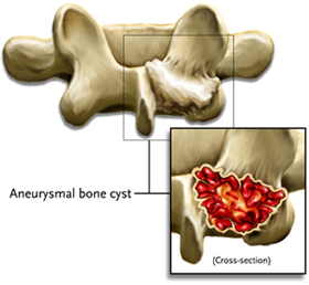 aneurysmal bone cyst